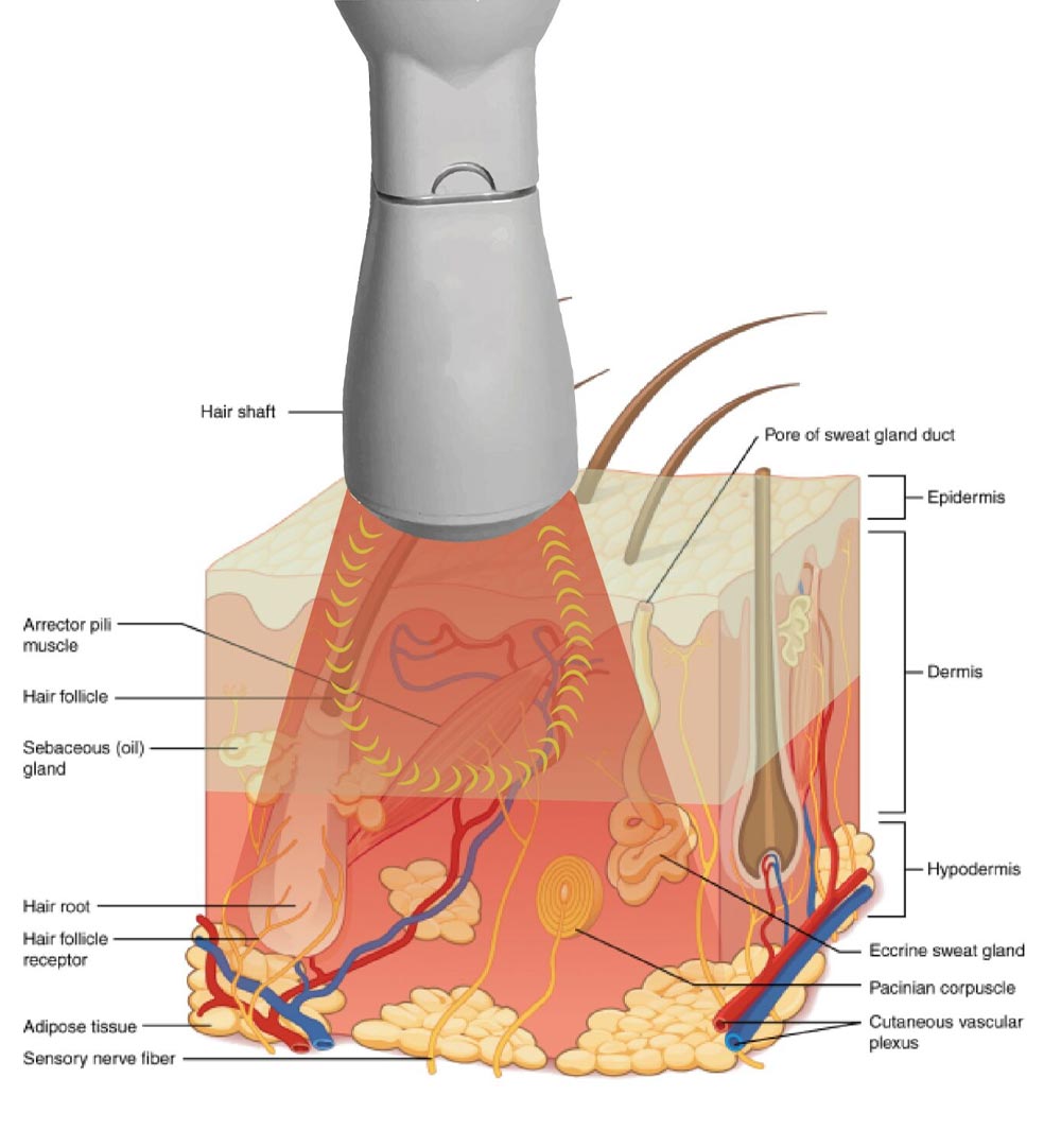 bipolare rf